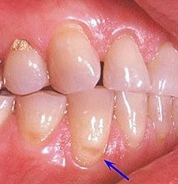 Image: Teeth showing a tooth abrasion.