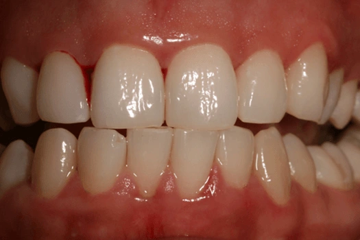 Image showing gingival bleeding and areas of inflammation despite little place accumulation