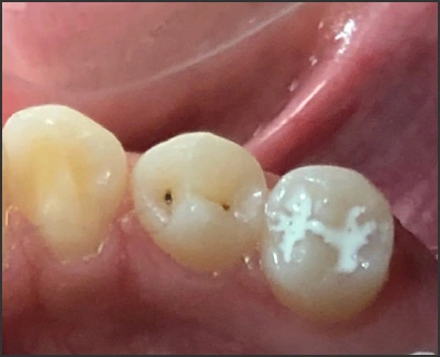 image showing occlusal sealants