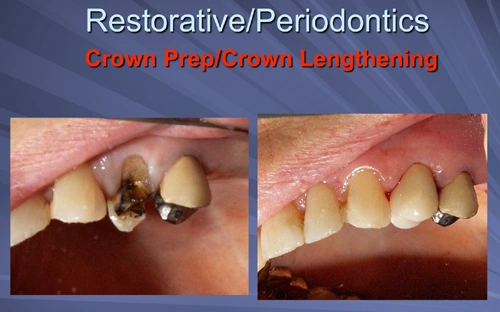 This image depicts the crown is delivered two weeks after the osseous crown lengthening.