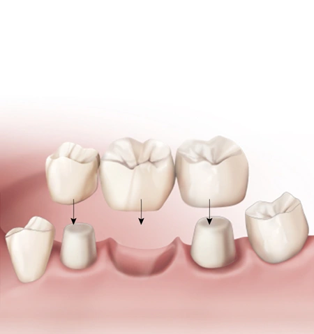 ce542 - Content - Crowns and Bridges - Figure 2