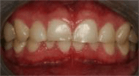 Photo of teeth with hard tissue loss involving greater than 50% of surface area