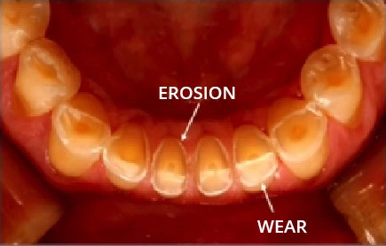 Photo showing multifactorial ETW with erosion and attrition.