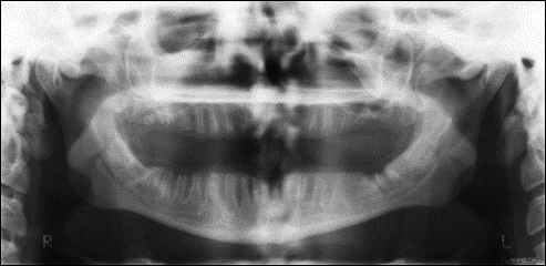 Adult Edentulous Patient - Radiographic Selection Criteria - Dentalcare