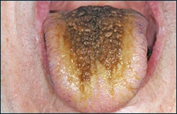 Image: Hairy Tongue