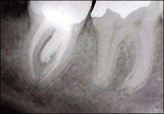 periapical radiograph showing bone lesion