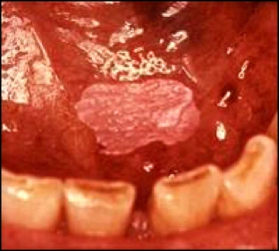 Photo showing leukoplakia under tongue.