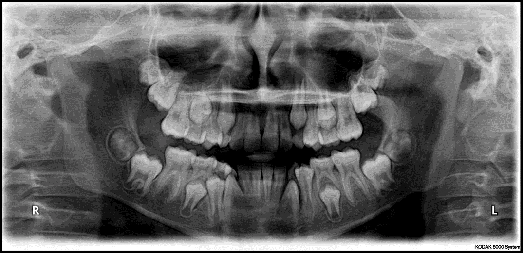 Causes and Appearance of Errors in Technique - Panoramic Radiographs ...