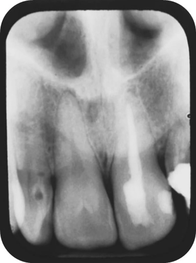 ce589 figure41
Periapical radiograph of tooth #7 with dens invaginatus Type I