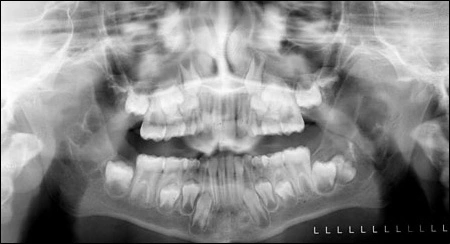 fig06-36mnth-pan-xray