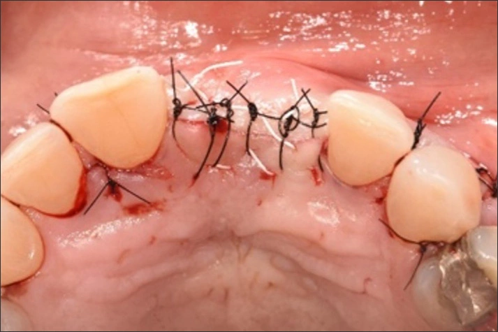 Surgical Technique - Figure 6