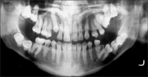 Panoramic radiographic image of multiple impacted molar teeth in various positions.