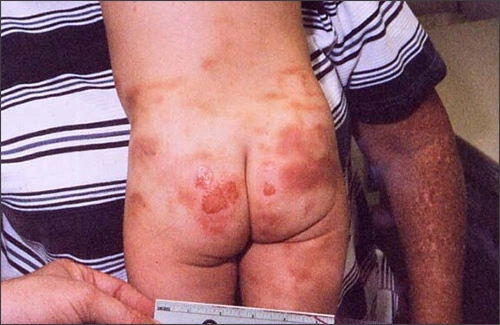 ce599 - Content - Neglect - Figure 1 Photo showing a severe case of diaper rash from caregiver neglect of the child.