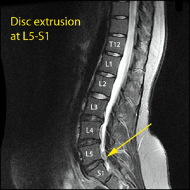 Image of disc extrusion.