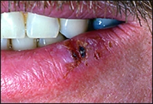 Waxing and waning erythematous ulceration with induration - biopsy-proven carcinoma-in-situ