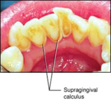 ce542 - Content - Dental Calculus - Figure 1