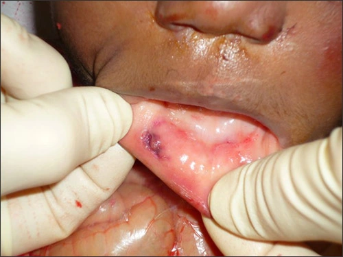 Photo showing torn labial frenum on a child abuse homicide victim.