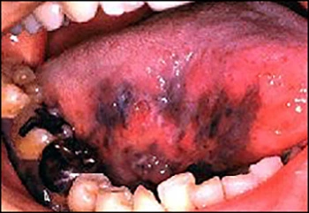 Image showing malignant melanoma