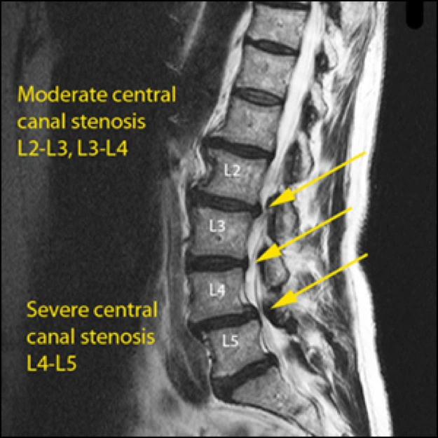 Image of central canal stenosis.