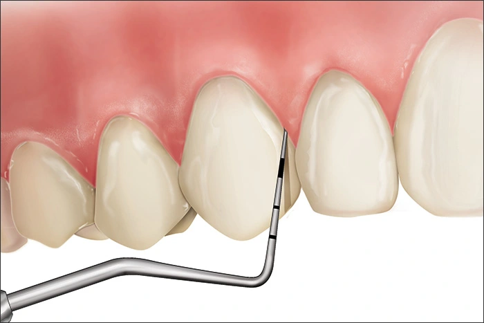 Illustration showing a Code 0 during periodontal probing