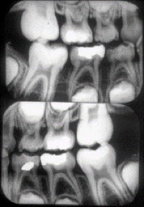 Radiograph of child bitewings