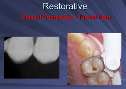 This image depicts a Class II Composite restoration tunnel preparation with Er:YAG laser without local anesthesia.