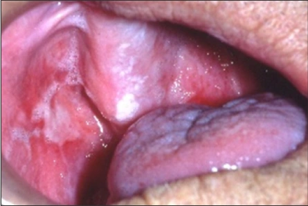 Acute radiotherapy-induced mucositis