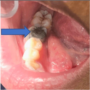 ce21-img02-amalgam