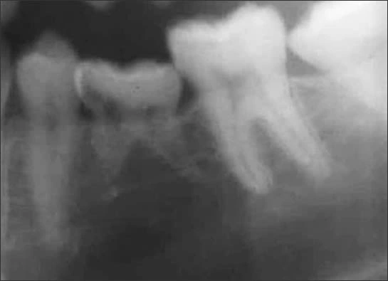 Cropped panoramic image of ankylosed primary tooth K.