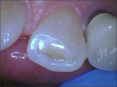 wear on lingual and occlusal surfaces