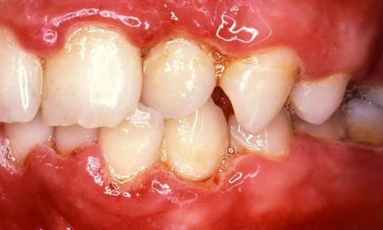 Photo showing necrotizing periodontal diseases