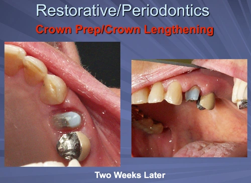 This image depicts the sulcular and attached gingiva are healing well at the crown delivery appointment two weeks after osseous crown lengthening.