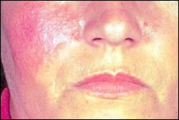 Image: Lupus erythematous