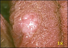 fig01-tongue-lesion