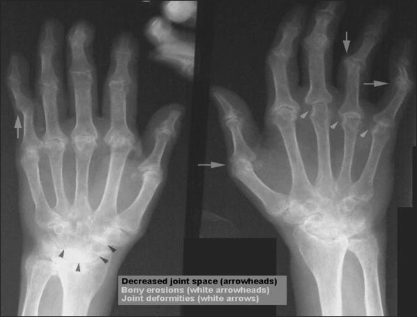 X-ray of patient with Rheumatoid Arthritis