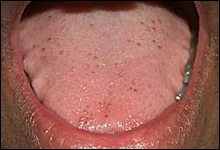 ce337 - Content - Tongue - Figure 6