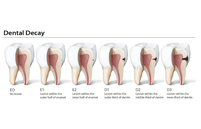 Patient Education Topic - Caries/Cavities