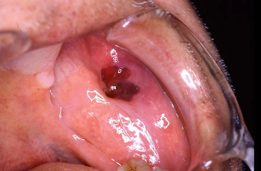 ce536 - Content - ADRs Affecting Oral Tissues - Figure 13