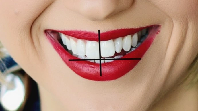 Smile Asymmetry - Figure 1
