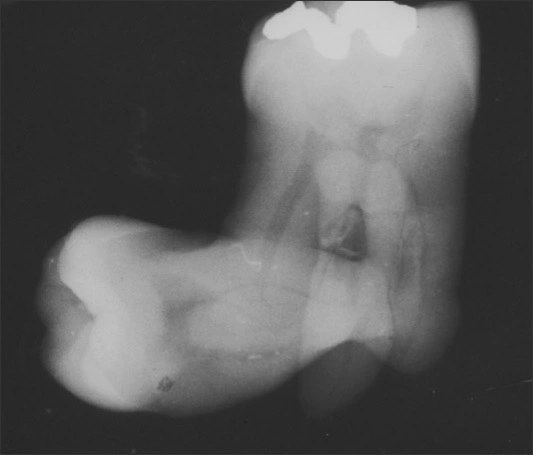 Conjoined Teeth - Figure 4