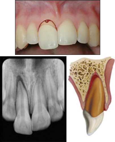 fig04-tooth-extrusion