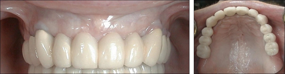 Photo showing a screw-retained prosthesis.
