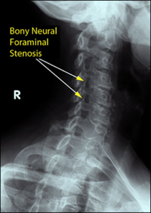 Image of stenosis.
