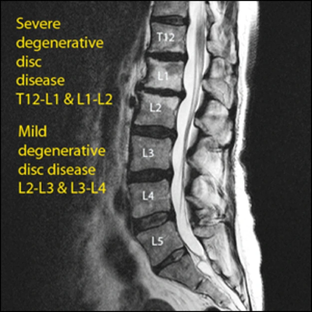 Image of degenerative disc disease.