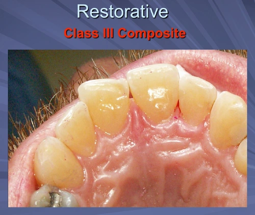 This image depicts a Class III Composite final restoration.