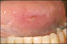 Case Challenge 23 - Content - Diagnostic Information - Figure 3 mucosal-atrophy