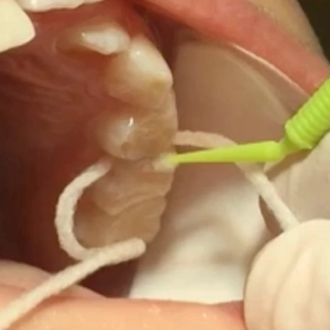 Minimally Invasive Treatment of Proximal Lesions (ce627) - Introduction