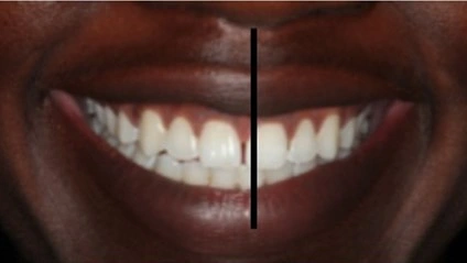 Dental Midline - Figure 1