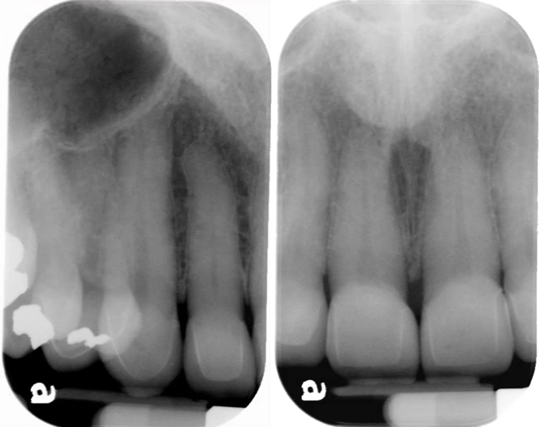 These radiographs show crowns made of lithium disilicate (often called e.max). They appear slightly radiopaque radiographically.