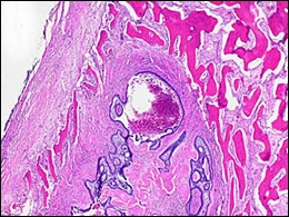 fig18-extension-to-bone